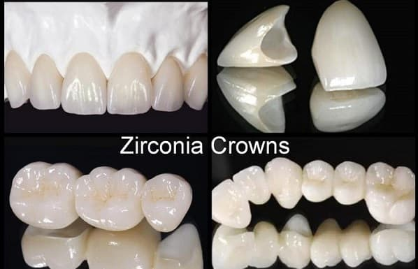 The image displays a collage of dental implants with varying stages of completion, showcasing different types of crowns and implant pieces against a black background.