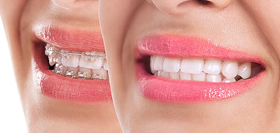 The image shows a person s face with an exaggerated smile, featuring bright pink lipstick and a close-up view, likely used for advertising dental care products or services.