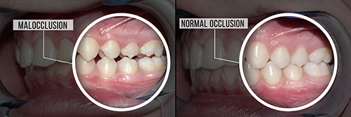 The image shows two photographs side by side, with the top photo illustrating a normal oral occlusion, while the bottom photo depicts a malocclusion.