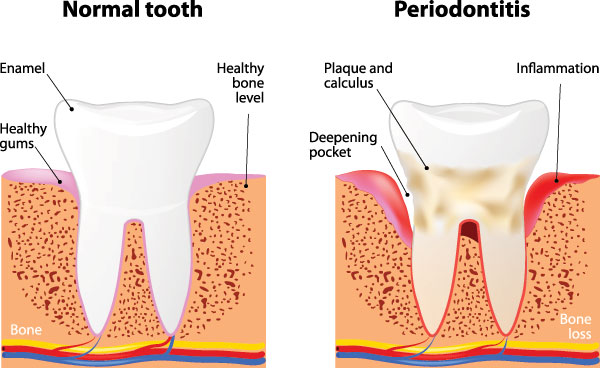 The image shows a three-panel illustration of dental decay progression from normal tooth to severe gum disease with bone loss, labeled as  periodontitis.