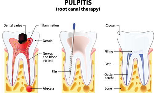 The image shows a diagrammatic representation of a dental procedure, specifically pulpitis, with labeled components such as  root canal therapy,   crown,   dentin,   neural vessels,   filling,  and  periapical abscess.  It illustrates the anatomy of a tooth s root system and the process of treating inflammation in the pulp.